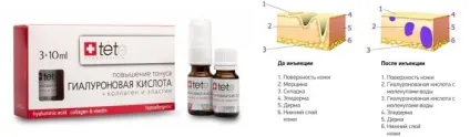 Мезотерапія - що це таке, ціни та відгуки (мезотерапія) Мезотерапія - що це таке, ціни і відгуки