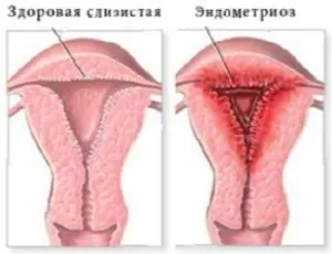 Чи можна засмагати при міомі матки або доведеться назавжди про це забути (це) Чи можна засмагати при міомі матки або доведеться назавжди про це забути
