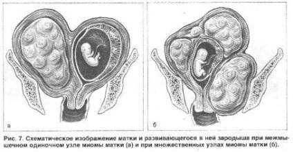 Чи можна засмагати при міомі матки - дізнайся докладно! (можна, можливо) Чи можна засмагати при міомі матки - дізнайся докладно!