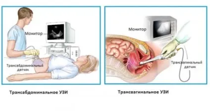 На який день циклу робити узі малого таза кіста яєчника на УЗД (який) На який день циклу робити узі малого таза кіста яєчника на УЗД