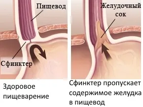 Недостатність кардії шлунка що це таке, причини і лікування (недостатність) Недостатність кардії шлунка що це таке, причини і лікування