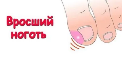 Народні методи лікування врослого нігтя