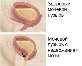 Мимовільне сечовипускання - причини, ознаки і лікування (мимовільне виділення урини) Мимовільне сечовипускання - причини, ознаки і лікування