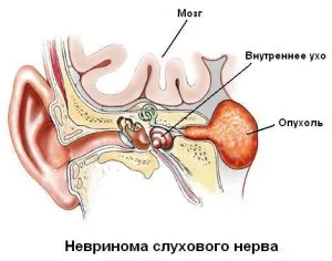Невринома слухового нерва лікування народними засобами