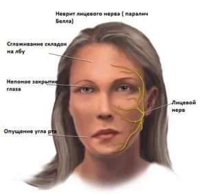 Неврит лицьового нерва причини і лікування запалення (нерва) Неврит лицьового нерва причини і лікування запалення