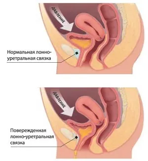 Мимовільне сечовипускання - причини, ознаки і лікування (мимовільне) Мимовільне сечовипускання - причини, ознаки і лікування