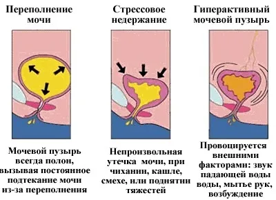 Мимовільне сечовипускання - причини, ознаки і лікування (мимовільне сечовипускання різновиди чоловіки жінки діти вагітність нетримання сеча виділення патологія) Мимовільне сечовипускання - причини, ознаки і лікування
