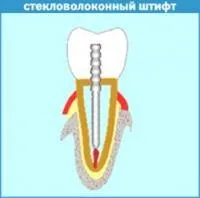 Нововведення стоматології, скловолоконні штифти дозволяють відновити цілісність зуба (спосіб життя) Нововведення стоматології, скловолоконні штифти дозволяють відновити цілісність зуба