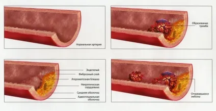 Облітеруючий атеросклероз ніг лікування (ложка сировини заливається склянкою) Облітеруючий атеросклероз ніг лікування