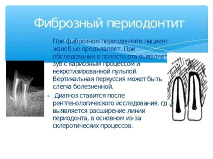 Загострення хронічного періодонтиту як виявляється фото (хронічного) Загострення хронічного періодонтиту як виявляється фото