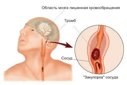 Як розпізнати інсульт симптоми і ознаки