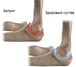 Операції на ліктьовому суглобі види і свідчення (ліктьовому) Операції на ліктьовому суглобі види і свідчення