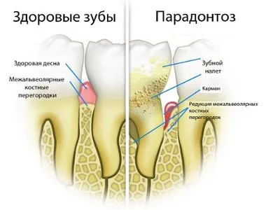 Пародонтоз етіологія, клініка і лікування, медична література, книги з медицини, підручники, (лікування) Пародонтоз етіологія, клініка і лікування, медична література, книги з медицини, підручники,