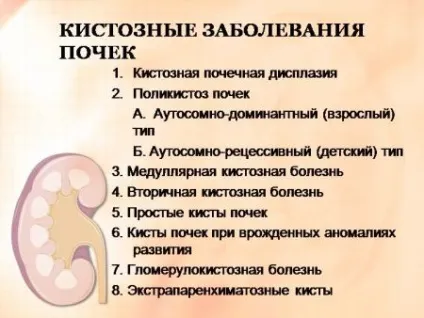Парехіматозная кіста нирки (правої або лівої) що це таке, лікування (кіста) Парехіматозная кіста нирки (правої або лівої) що це таке, лікування