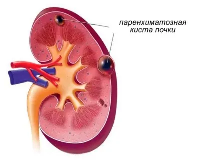 Паренхіматозна кіста лівої нирки - що це таке, симптоми (нирки) Паренхіматозна кіста лівої нирки - що це таке, симптоми