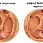 Перихондрит вушної раковини симптоми, фото, лікування (перихондрит зовнішнє вухо запалення вушної раковини надхрящніца фото причини види симптоми методи лікування) Перихондрит вушної раковини симптоми, фото, лікування