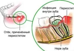 Периостит нижньої щелепи запалення окістя верхньої щелепи (окістя) Периостит нижньої щелепи запалення окістя верхньої щелепи