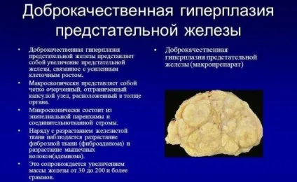 Пієліт (запалення ниркової балії) симптоми і лікування (ниркової) Пієліт (запалення ниркової балії) симптоми і лікування