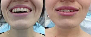 Пластика губ методи хейлопластики, що дозволяють домогтися виразного контурного обриси, фото (фото) Пластика губ методи хейлопластики, що дозволяють домогтися виразного контурного обриси, фото