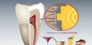 Чому болить зуб після лікування карієсу (болить) Чому болить зуб після лікування карієсу