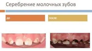 Чому кришаться зуби у дорослих і у дітей причини і що робити (чому кришаться зуби) Чому кришаться зуби у дорослих і у дітей причини і що робити