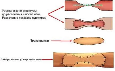 пластика уретри