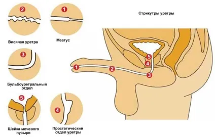 пластика уретри