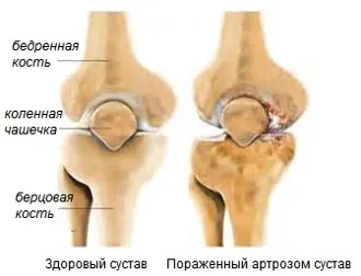 Чому скриплять коліна причини і лікування (артрозі колінного суглоба) Чому скриплять коліна причини і лікування