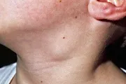 Наслідки вич і СНІДу