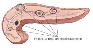 Підвищена ехогенність підшлункової залози що це значить, причини, лікування (залози) Підвищена ехогенність підшлункової залози що це значить, причини, лікування
