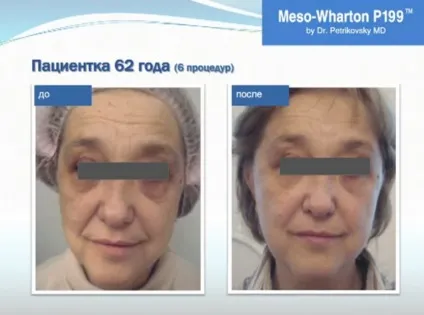 Препарат мезовартон (meso-wharton), відгуки на процедуру біоревіталізації (препарат) Препарат мезовартон (meso-wharton), відгуки на процедуру біоревіталізації