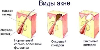 Прищ на носі (зліва, справа, на кінчику) народні прикмети