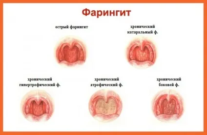 Причини появи пухирів в горлі і бульбашок (появи) Причини появи пухирів в горлі і бульбашок