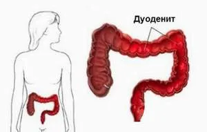 Проксимальний дуоденіт поверхневий, ерозивний, що це таке (проксимальний) Проксимальний дуоденіт поверхневий, ерозивний, що це таке