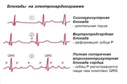 пучок Гіса