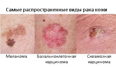 Рак шкіри симптоми, ознаки та фото (ознаки раку шкіри) Рак шкіри симптоми, ознаки та фото