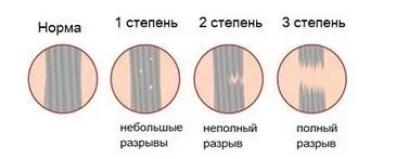 Розтягнення зв'язок колінного суглоба лікування в домашніх умовах (суглоба) Розтягнення зв'язок колінного суглоба лікування в домашніх умовах