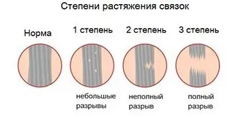 Розтягнення зв'язок на нозі симптоми і лікування в домашніх умовах (симптоми) Розтягнення зв'язок на нозі симптоми і лікування в домашніх умовах