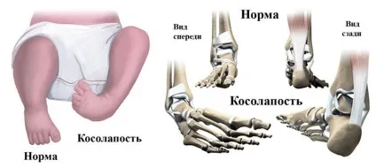 Дитина клишоногий на одну ногу поради батькам (деформація суглобів стопи) Дитина клишоногий на одну ногу поради батькам