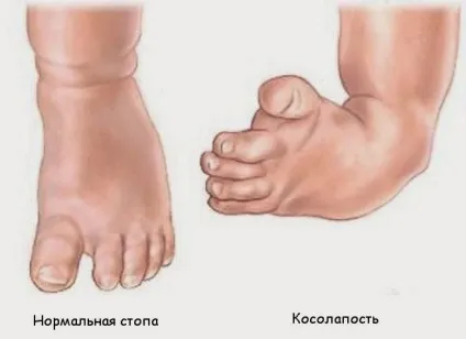 Дитина клишоногий на одну ногу поради батькам (дитина) Дитина клишоногий на одну ногу поради батькам