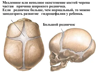 Родничок у новонароджених коли заростає - види джерелець, норми і патології! (Новонароджених) Родничок у новонароджених коли заростає - види джерелець, норми і патології!