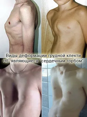 серцевий горб