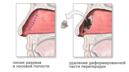 Септопластика (пластика носової перегородки) - ціна, фото до і після, відгуки пацієнтів (септопластика) Септопластика (пластика носової перегородки) - ціна, фото до і після, відгуки пацієнтів