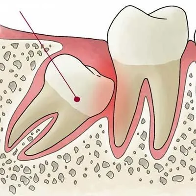 Синус ліфтинг в стоматології (закритий і відкритий) (синус ліфтинг закритий відкритий відео стоматологія ускладнення що) Синус ліфтинг в стоматології (закритий і відкритий)