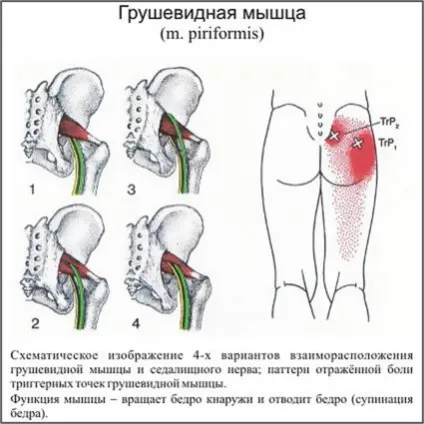 Синдром грушоподібної м'язи симптоми і лікування (синдром грушоподібної м'яз лікування симптоми) Синдром грушоподібної м'язи симптоми і лікування