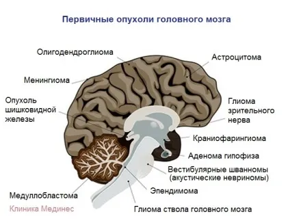 Скільки живуть з раком головного мозку - персональна медицина (рак) Скільки живуть з раком головного мозку - персональна медицина