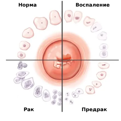 Способи лікування ерозії шийки матки у родили жінок свічками, хіміофіксаціей (способи) Способи лікування ерозії шийки матки у родили жінок свічками, хіміофіксаціей