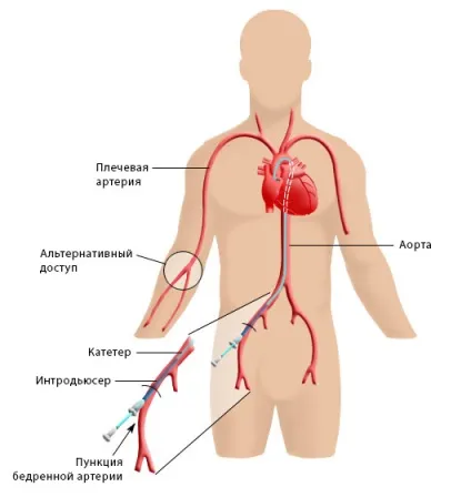 Стентування коронарних артерій