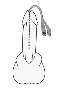 стриктура Урет