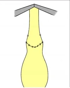 стриктура Урет